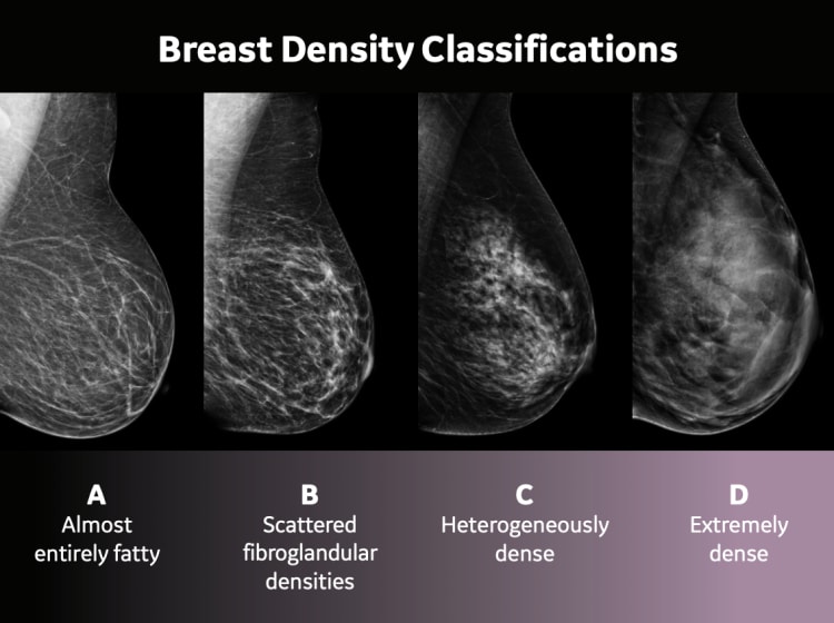breast density classifications